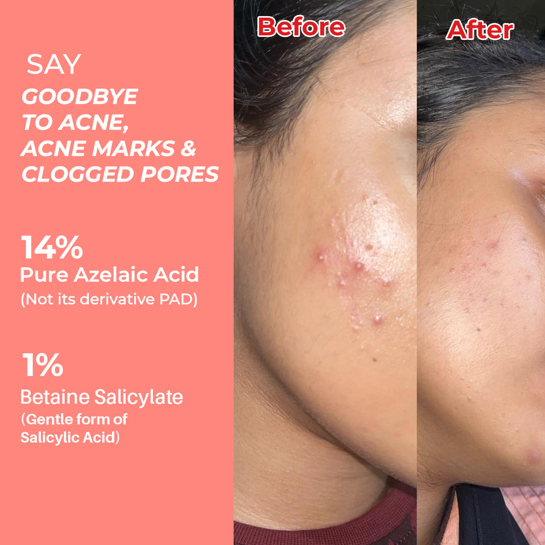 Porebright - Advance Anti Acne Serum